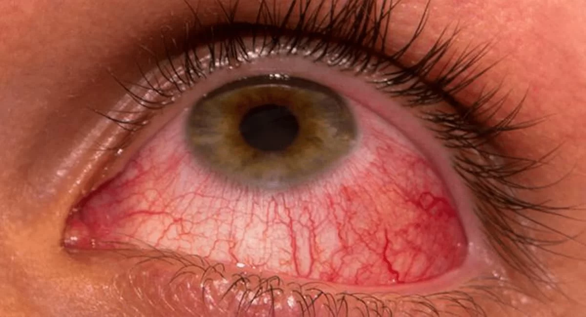 Cornea and External Eye Disease Clinic